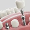 Single Dental Implant